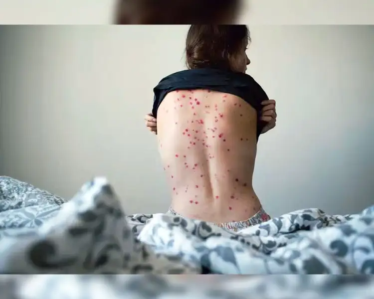 Detectan peligrosa variante de viruela del mono en Tailandia