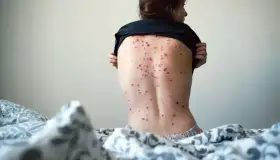 Detectan peligrosa variante de viruela del mono en Tailandia