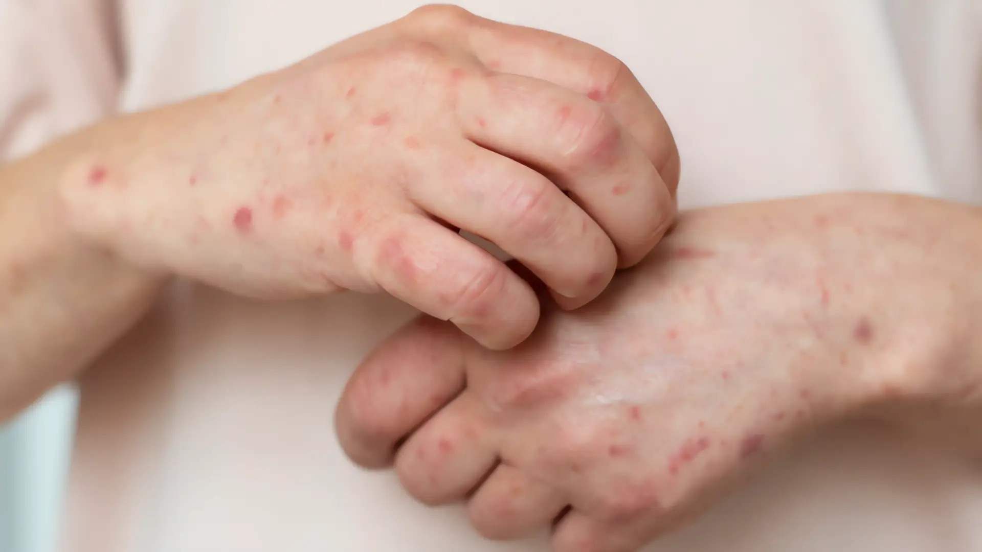 Brote de sarampión en México: Más de 1,900 casos confirmados
