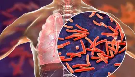 Tuberculosis vuelve a propagarse en el mundo: OMS